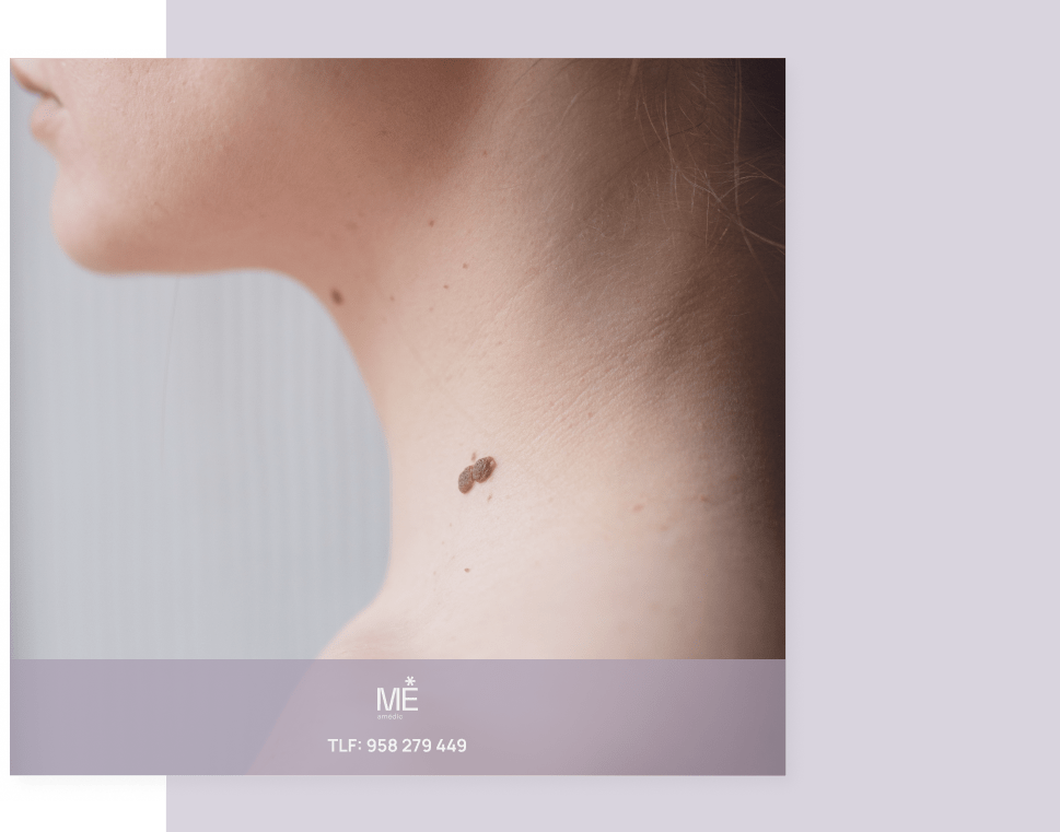 banner para verrugas de tablet