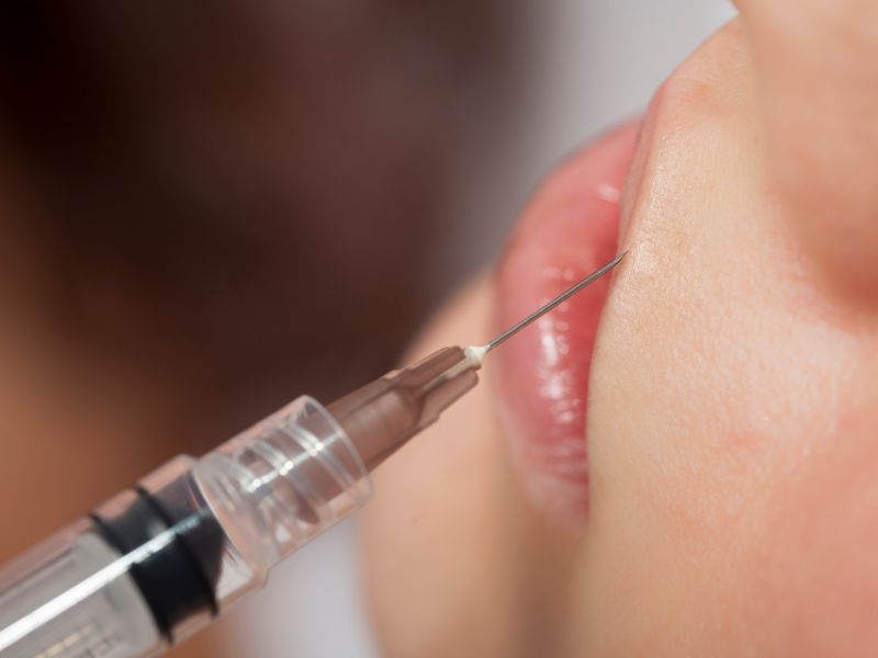 tratamiento de ácido hialurónico para combatir arrugas en labios