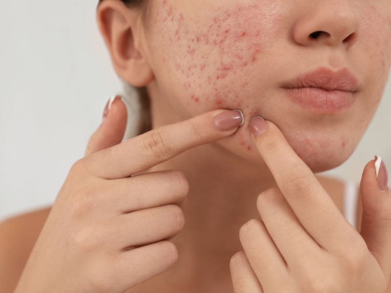 consejos para prevenir el acné sin tocarlo