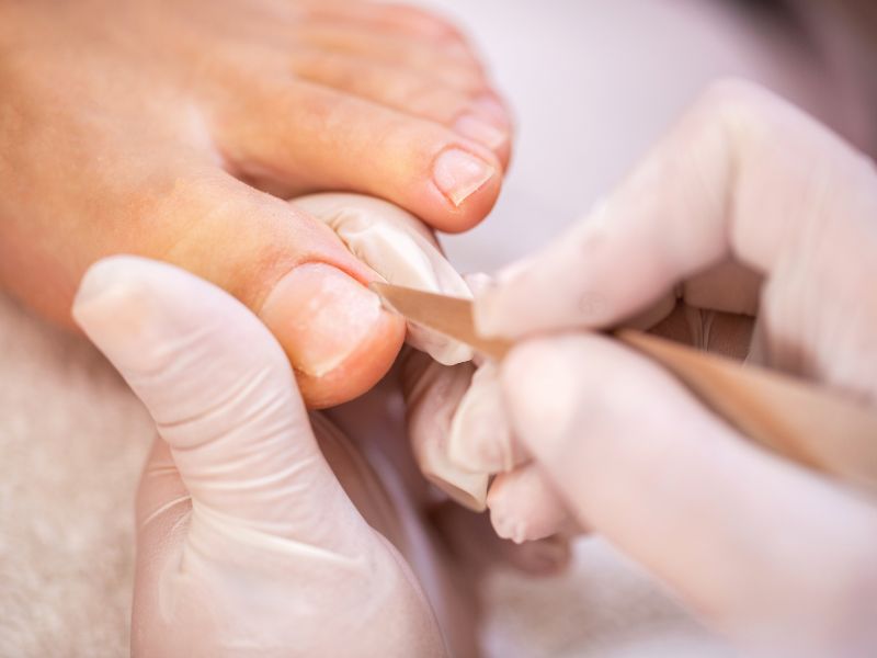 tratamiento de quiropodia