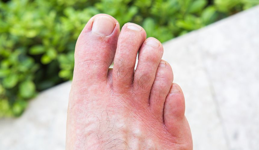 ensanchamiento del pie