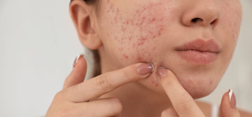 quitar granos de la cara