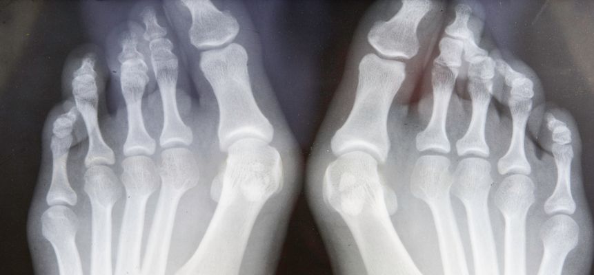 radiografía del pie con juanetes